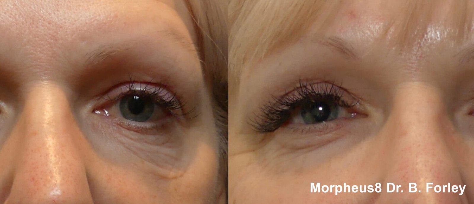 morpheus8-before-after-dr-b-forley-preview-1-(1) (1)