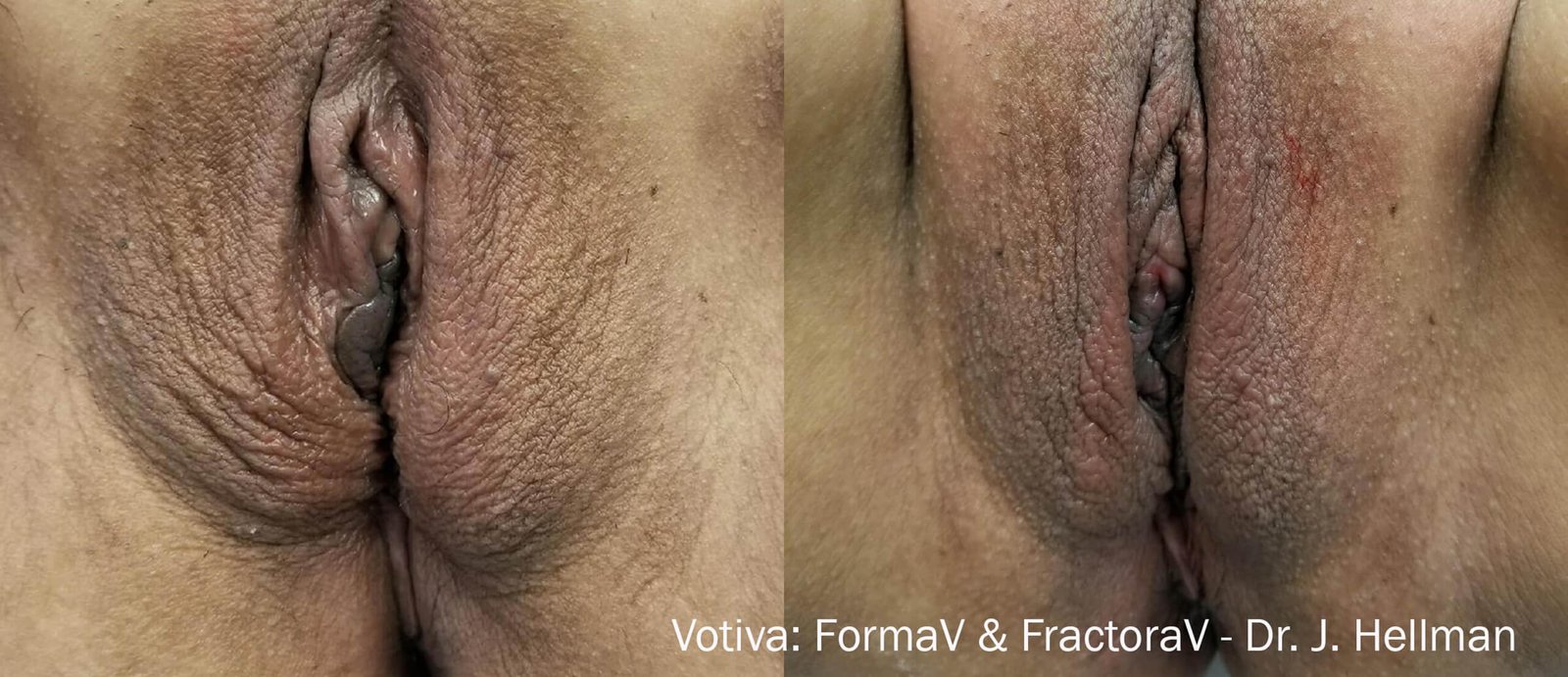 votiva-before-after-dr-j-hellman-preview-2-(1) (1)